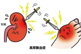 尿酸升高莫要慌，及时治疗保健康图片