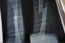 中医回老家期间出手正骨，就地取材做固定夹板，益阳5岁男孩左腿恢复健康图片