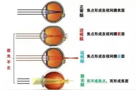 中医药特色技术│潍坊市中医院“通络明目七法”治疗儿童视力下降图片