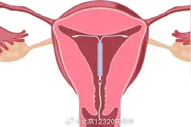 避孕环超过年限没有取出，会有什么后果？图片