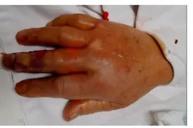 警惕创伤弧菌！男子被鱼刺扎了下，遭截指、差点丧命图片