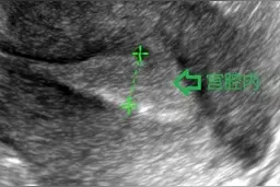 早孕期胎儿如何成长？超声诊断为您揭晓！图片