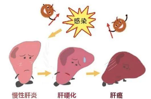 关于丙型病毒性肝炎，这些知识你要了解