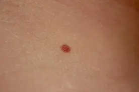 皮肤上长出的小红点，到底是什么？图片