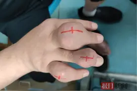 触目惊心！男子手脚长满“石头疙瘩”，竟是痛风反复作祟图片