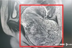 一年时间臀部长出25厘米肿物！医生：脂肪源性肿瘤别大意图片