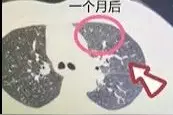 肺癌术后一年又现阴影！竟是“吃出来的”？图片