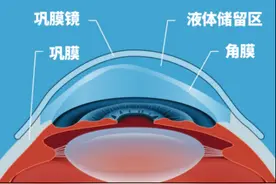 湖北首例！量身定制“大号隐形眼镜”或成这类眼疾患者新选择！图片