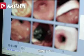 爱吃柿子患上胃结石，老人喝可乐来治，结果悲剧了……图片