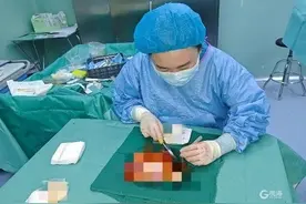 女子头皮被整个撕脱！意外居然发生在这...想想就痛！图片