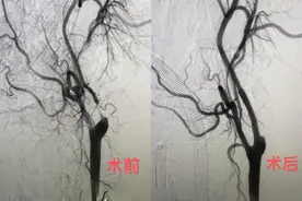 广东省人民医院完成华南首例颈动脉狭窄治疗新术式图片