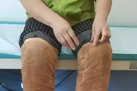 大夏天还要裹上棉裤！这种病，久坐的年轻人也会中招图片