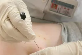 一根针、几条线就能管理体重，这类人更适合图片