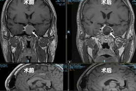 越长越丑，可能是因为脑内长了垂体瘤图片