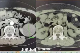 体检查出肾囊肿，中医大一附院手术选用“微创中的微创”图片