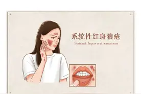 最近大家又在关注的红斑狼疮，这些知识听专家来解答→图片