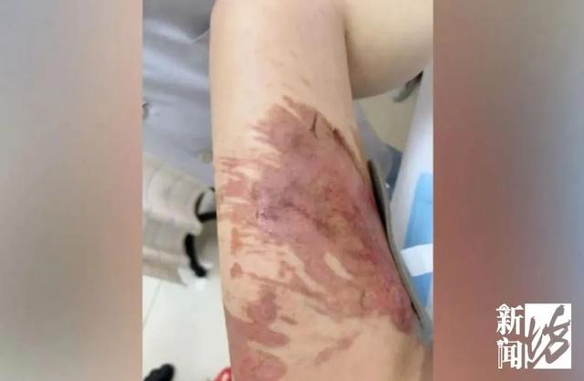把手断裂 火锅店整壶高汤浇母女身上