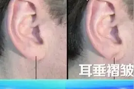 血管不好从脸上、腿上就能看出来 有这6个症状要警惕！图片