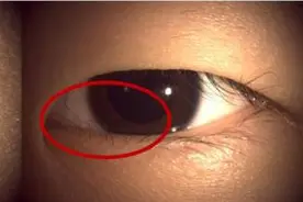 睫毛倒长还戴塑形镜？这个“危险组合”可能让孩子的角膜伤痕累累图片