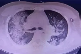 全力救治|阳光融和医院急诊医学科成功救治一名重症肺炎患者图片