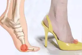 专家支招爱美女士，别让“水晶鞋”内的双脚受伤了图片