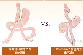 规范微创外科手术治疗2型糖尿病，全国多中心高质量临床研究招募进行时！图片