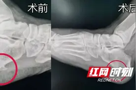 宁乡市人民医院：小镜子挑除“肉中刺” 跟骨骨刺也能微创解决图片
