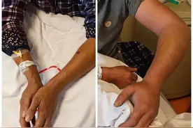 瞬间一阵剧痛，男子在家被“竹叶青”咬伤！医生：毒蛇冬眠后毒性更强图片