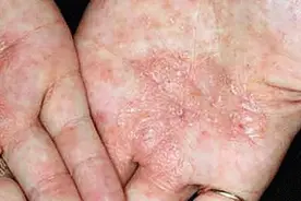 奇痒无比！这种夏天手上超爱长的“小水泡”，到底如何应对？图片