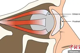 国际最新研究：3D打印出更逼真义眼  外观更自然适配度更好图片