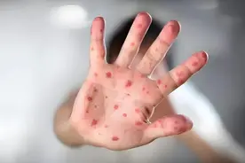 家长请注意！这种病已到高发期图片