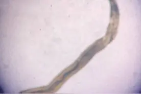 吓人！昆明一患者眼内取出1.5厘米长活虫！医生提醒图片