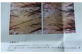 头油头痒，竟然需要去医院做检查？头上长了这种虫卵要当心！图片