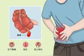 阑尾炎不开刀！株洲市中心医院率先开展内镜下阑尾炎治疗技术图片