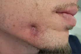 皮肤病变原因竟是牙齿感染 这些问题不能忽视图片