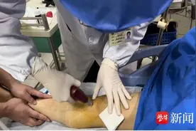男子车祸重伤血管塌陷无法输液，急诊团队“骨髓输液”搭建“生命通道”图片