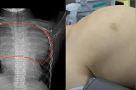 7岁男孩看似“鸡胸”实则隐藏巨大肿瘤！新华专家5个小时完整“拆弹”图片