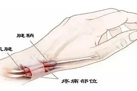 “抓大鹅”抓出“腱鞘炎”，别让游戏玩坏你的手！图片