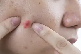 科普｜如何战胜“青春痘”？图片