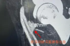 生死时速，全力以赴 市六院援藏专家“另辟蹊径”挽救危重症患者生命图片