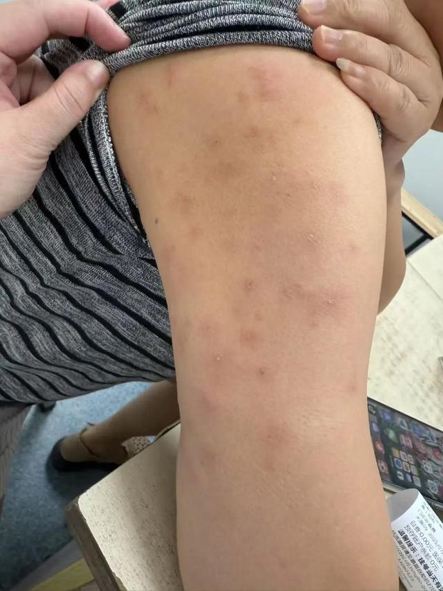 痒痒痒！一觉醒来身上十几个包！医生：这件事情很多人都做错了