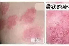 带状疱疹该如何预防？济南疾控发布重要提醒图片