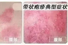 带状疱疹该如何预防？济南疾控发布重要提醒图片