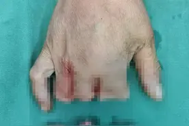 全断了，果断转院！ 显微镜下“走钢丝”，为她再植“复活”三根断指图片