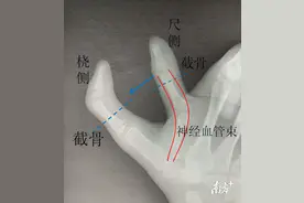 儿童复杂拇指多指畸形，汕头市中心医院医生巧手拼接矫治图片