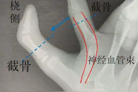儿童复杂拇指多指畸形，汕头市中心医院医生巧手拼接矫治图片