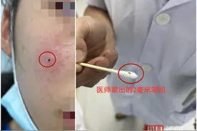 铅笔芯扎入脸颊，小学生险毁容图片