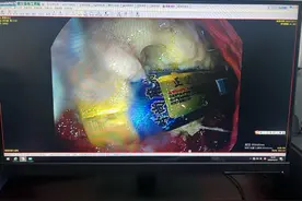 南昌一男子误吞9厘米长打火机，医生用圈套器慢慢取出图片