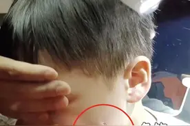 爸爸钓鱼不慎将鱼钩甩到8岁儿子脸上，消防赶到医院成功取下，网友：看着都疼图片