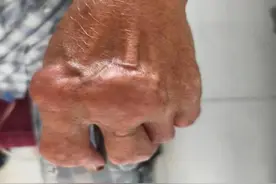 手指频频发炎、手背肿起“小山”！八旬爷爷痛不欲生，原来是“石头”作祟图片